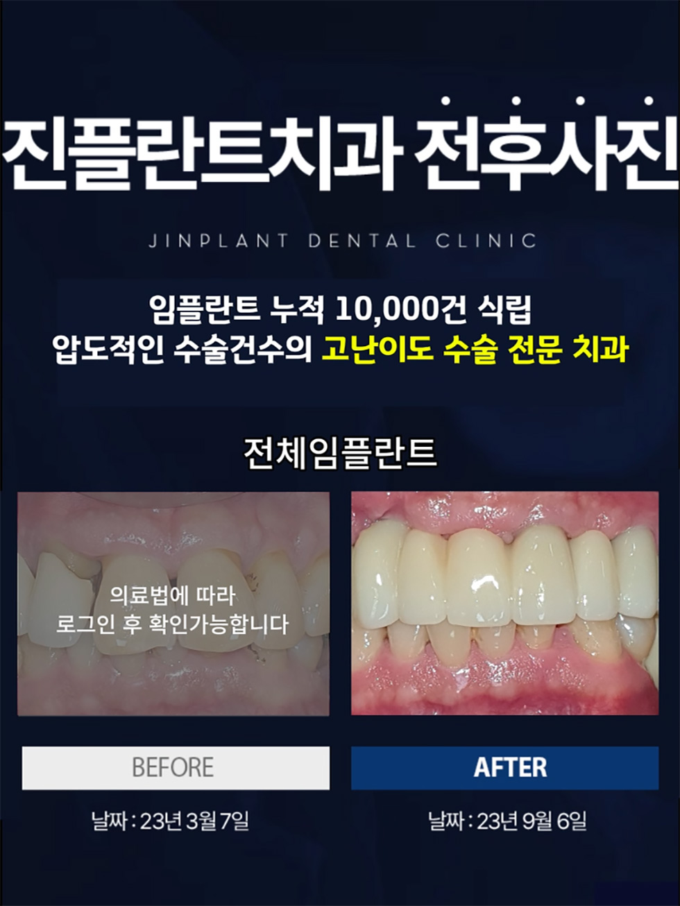 ���ö�Ʈġ�� ���Ļ��� JINPLANT DENTAL CLINIC ���ö�Ʈ ���� 10,000�� �ĸ� �е����� �����Ǽ��� �����̵� ���� ���� ġ�� ��ü���ö�Ʈ